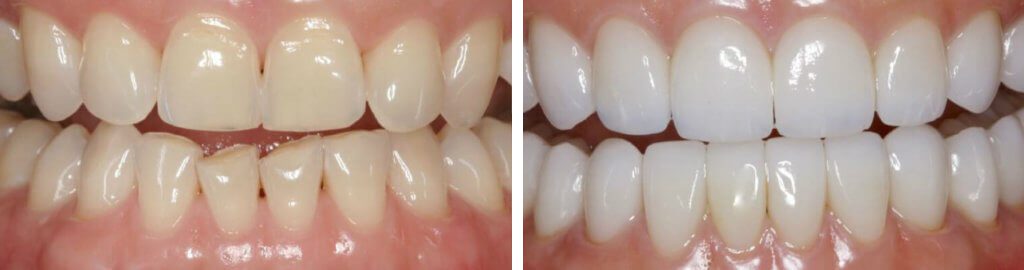Teeth 3 Before Watkin Dental Associates